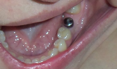 имплантация зуба